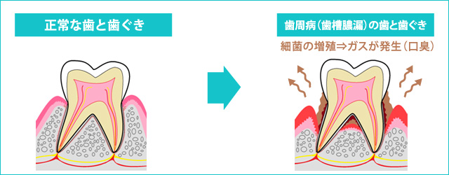 あなたは大丈夫 不快な口臭 その原因と対策 歯周病専用歯磨き粉のプロポリス健康増進会